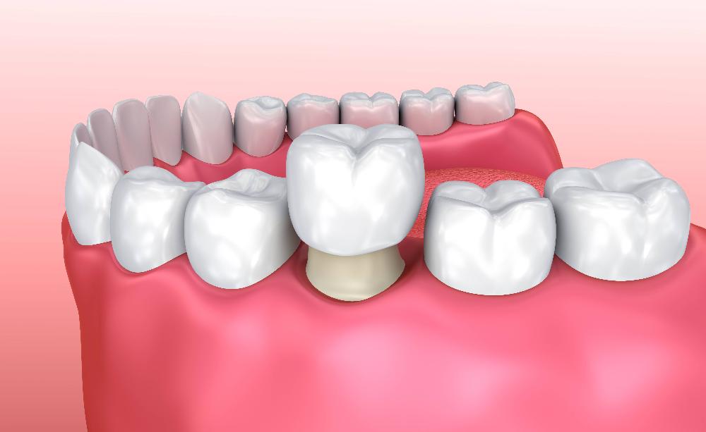 close up of dental crown
