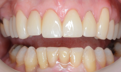 After treatment - Clear Aligners and Crowns/Veneers 
