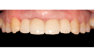 After treatment - Dental Implant and Bridge Treatment