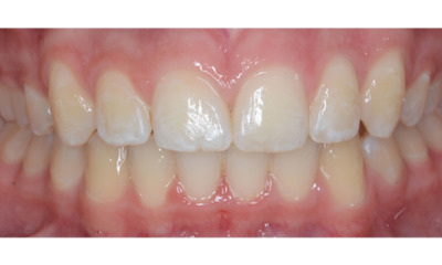 After treatment - Fixed Orthodontic Treatment