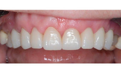 After treatment - Gum Lift, Crown and Veneers 