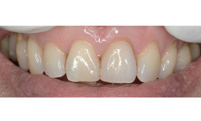 After treatment - Single Crown Colour Matching 