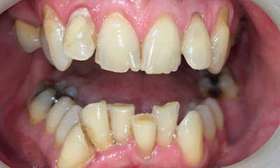Before treatment - Clear Aligners and Crowns/Veneers 