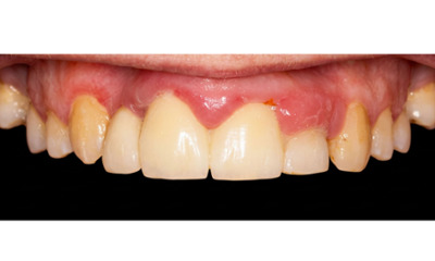 Before treatment - Dental Implant and Bridge Treatment