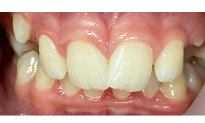 Before treatment - Fixed Orthodontic Treatment
