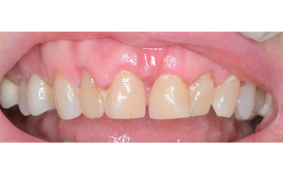 Before treatment - Gum Lift, Crown and Veneers 