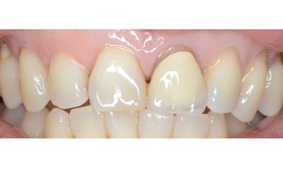 Before treatment - Single Crown Colour Matching 